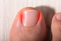 Possible Causes of Ingrown Toenails