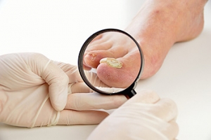 Am I More Likely to Develop Toenail Fungus?