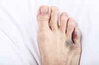 Factors Behind a Fractured Pinky Toe
