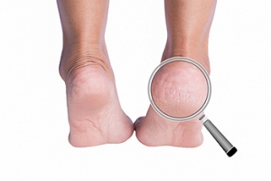 Pedicures and Cracked Heels