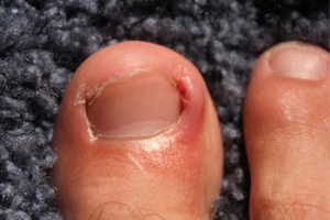 What Causes Ingrown Toenails?