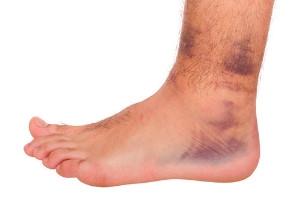 How Do Ankle Sprains Occur?
