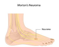 Morton’s Neuroma and Shoes